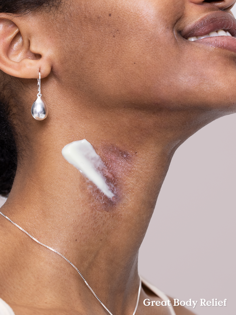 Model with Great Body Relief lotion applied onto her scar on neck